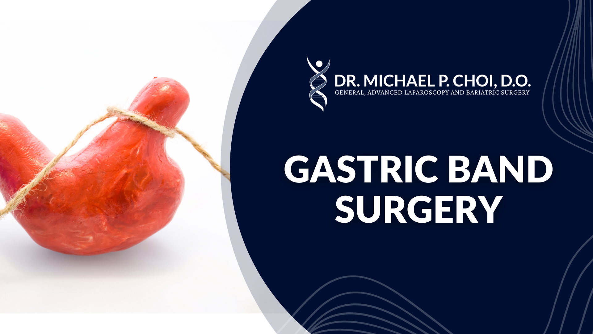 GASTRIC BAND SURGERY
