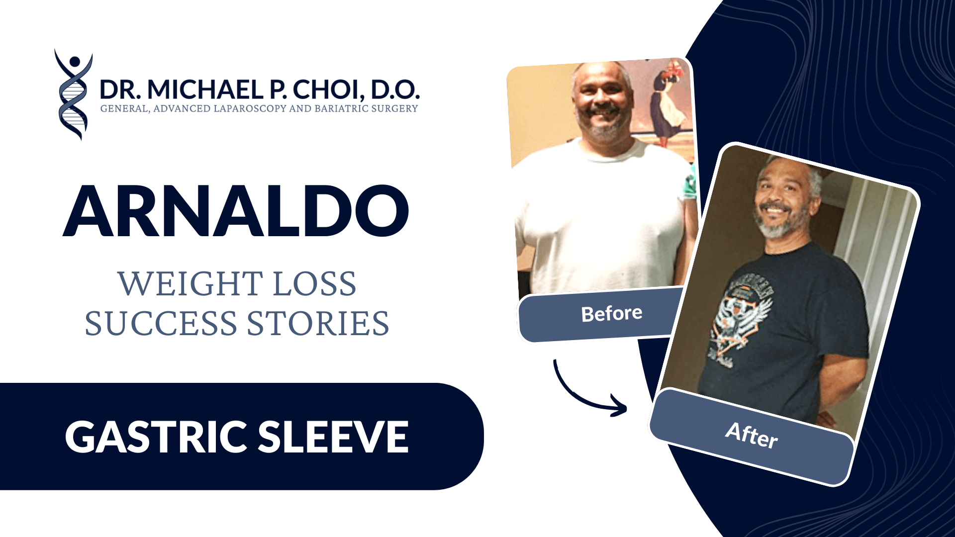 Arnaldo weight loss success stories - gastric sleeve surgery