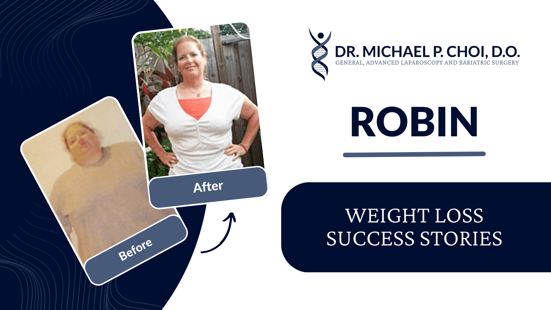 Robin weight loss success stories - lap band surgery