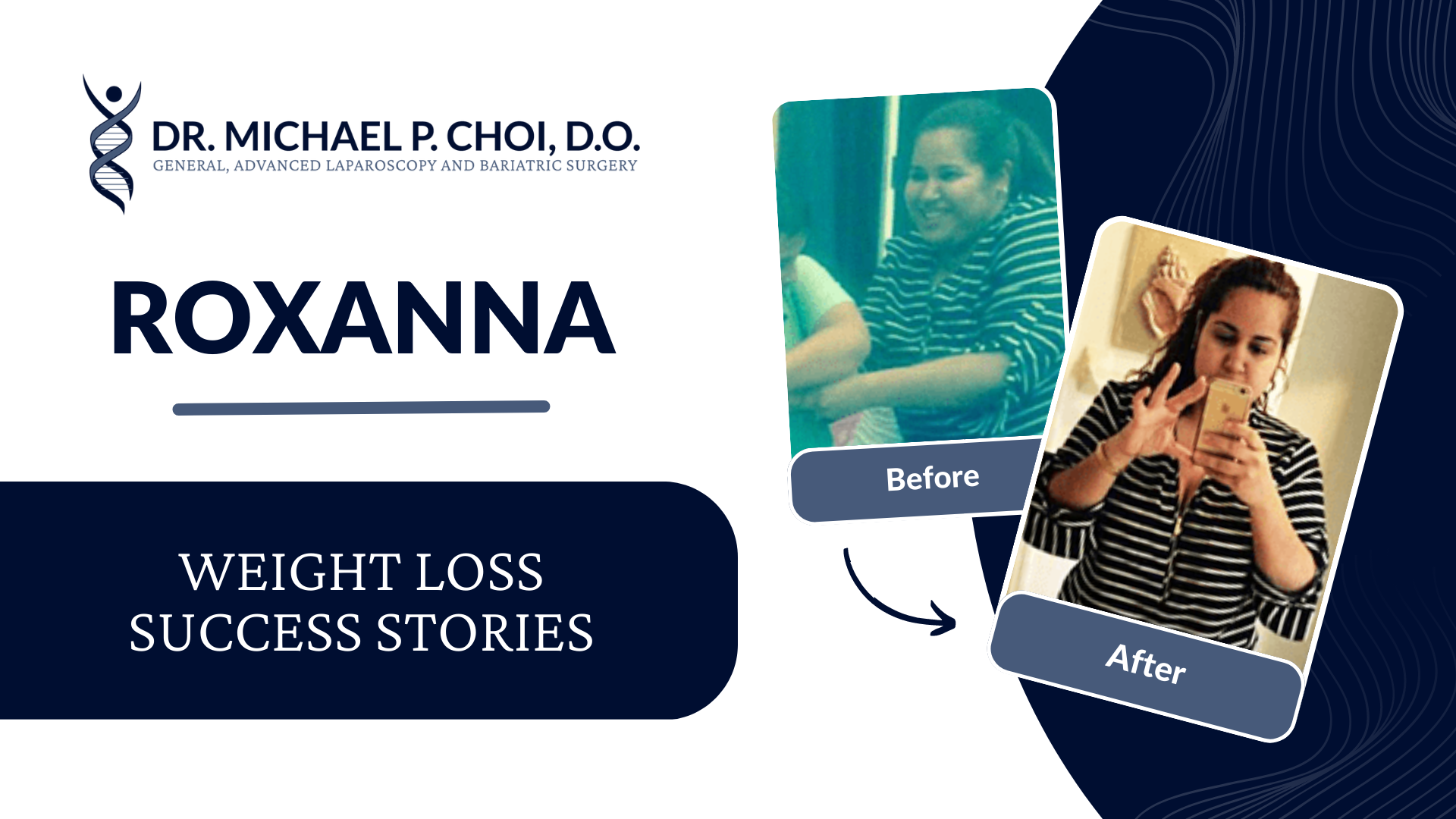 Roxanna R weight loss success stories - gastric sleeve surgery